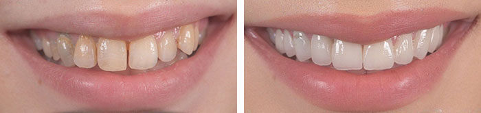 before & after photo of Dental Veneers