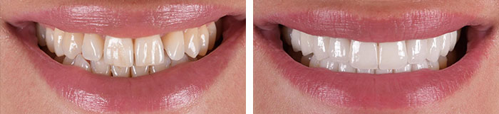 before & after photo of Dental Veneers