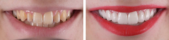 before & after photo of dental-veneers