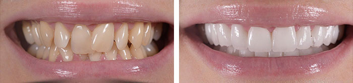 before & after photo of Dental Veneers