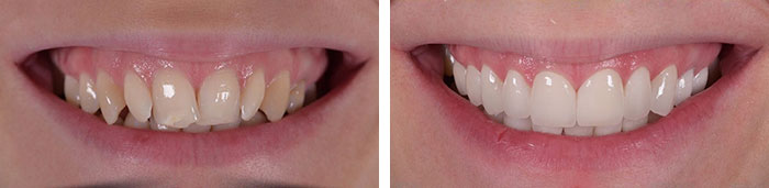 before & after photo of Dental Veneers