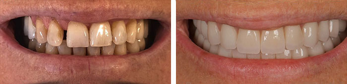 before & after photo of Dental Veneers