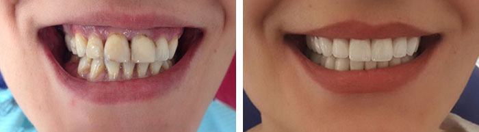 before & after photo of Dental Veneers