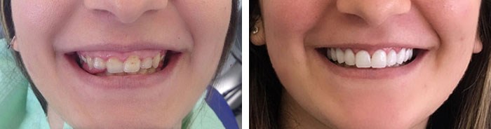 before & after photo of Dental Veneers