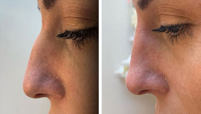 before & after photo of nose-filler