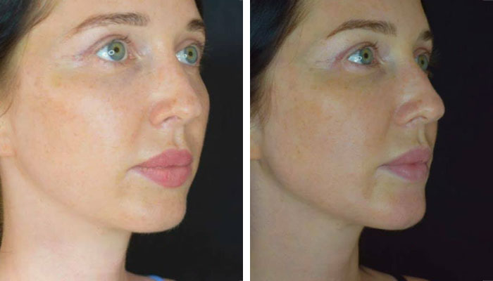 before & after photo of chin-jawline-filler