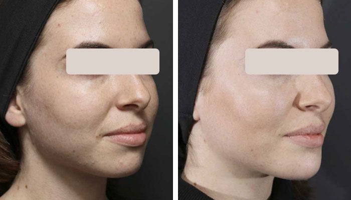 before & after photo of Chin and Jawline Filler