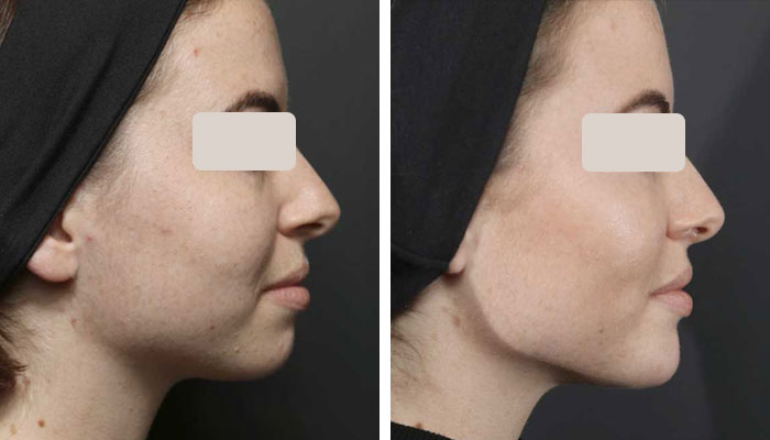 before & after photo of cheek-filler