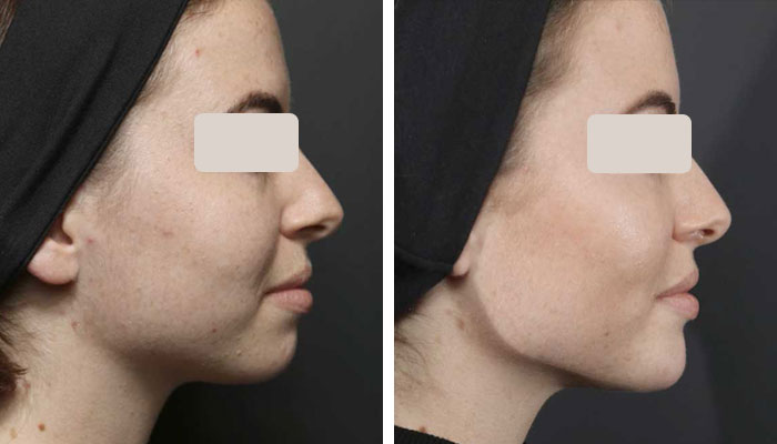 before & after photo of Chin and Jawline Filler