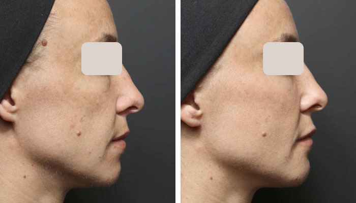 before & after photo of Cheek Filler