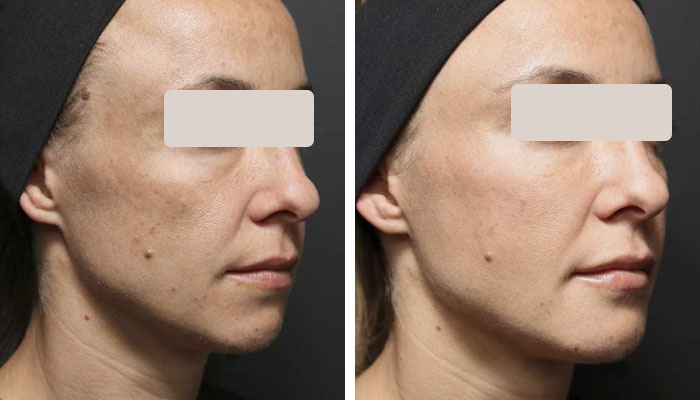 before & after photo of cheek-filler