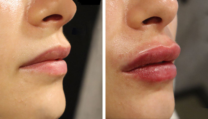 before & after photo of lip-filler