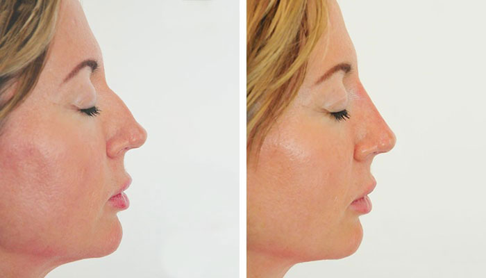 before & after photo of nose-filler