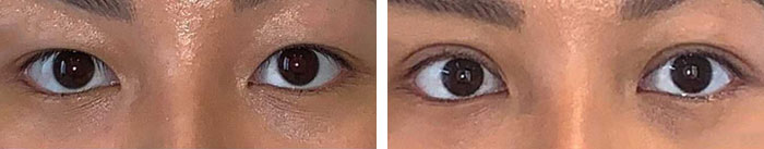 before & after photo of Double Eyelid Surgery
