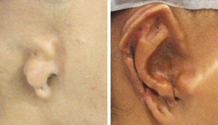 before & after photo of Ear Reconstruction Surgery