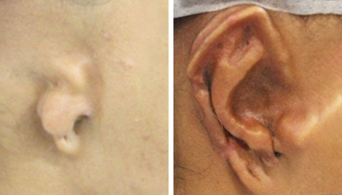 before & after photo of ear-reconstruction-surgery