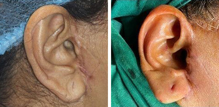 before & after photo of Ear Reconstruction Surgery