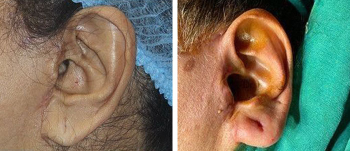 before & after photo of Ear Reconstruction Surgery