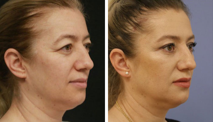 before & after photo of eyelid-surgery