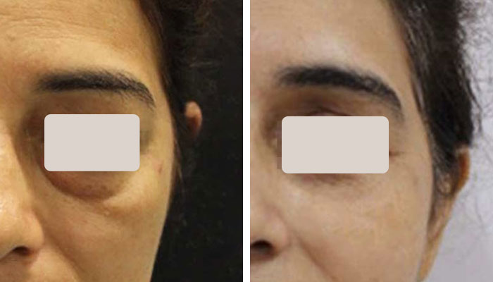 before & after photo of عملية تجميل الجفون