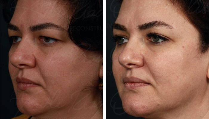 before & after photo of Eyelid Surgery
