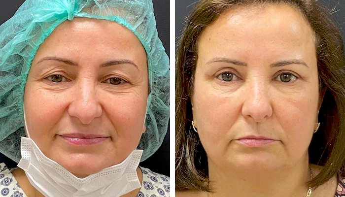 before & after photo of eyelid-surgery