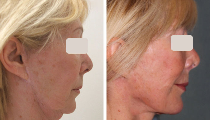 before & after photo of Neck Lift