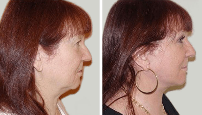 before & after photo of Facelift