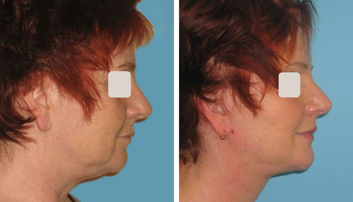 before & after photo of neck-lift