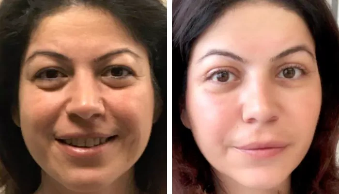 before & after photo of Mommy Makeover