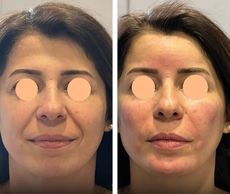 before & after photo of Facial Fat Transfer