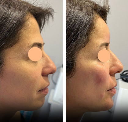 before & after photo of Facial Fat Transfer