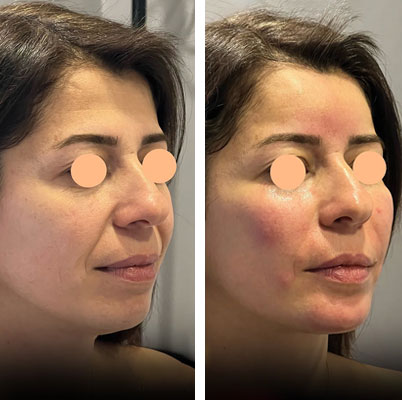 before & after photo of Facial Fat Transfer