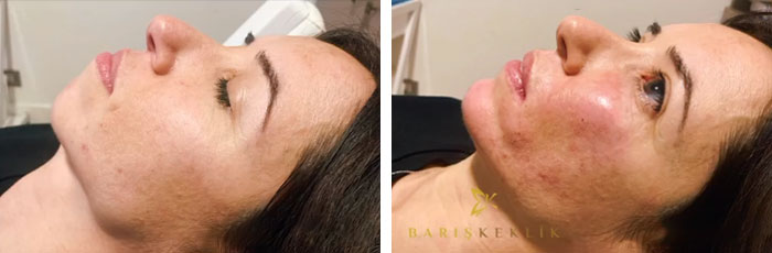 before & after photo of Facial Fat Transfer