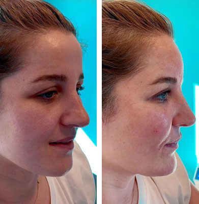 before & after photo of Facial Fat Transfer