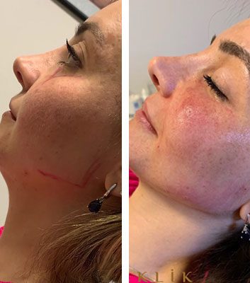 before & after photo of Facial Fat Transfer