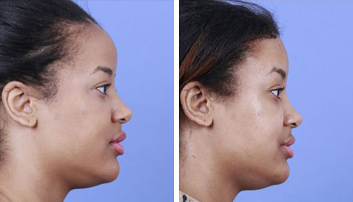 before & after photo of hairline-lowering-scalp-advancement