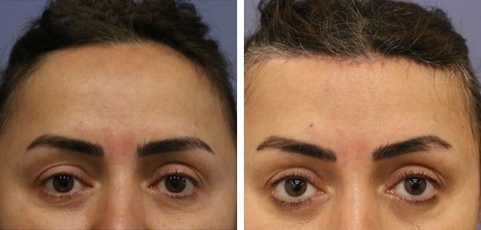 before & after photo of تخفيض خط الشعر (تقديم فروة الرأس)