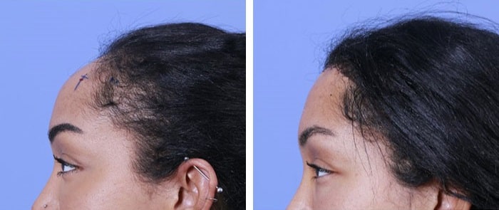 before & after photo of تخفيض خط الشعر (تقديم فروة الرأس)
