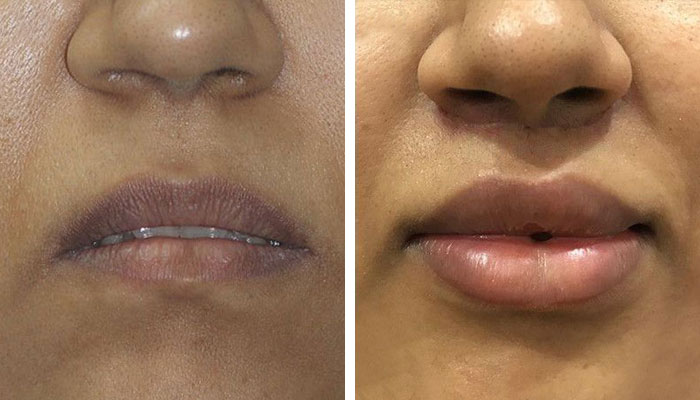 before & after photo of lip-lift