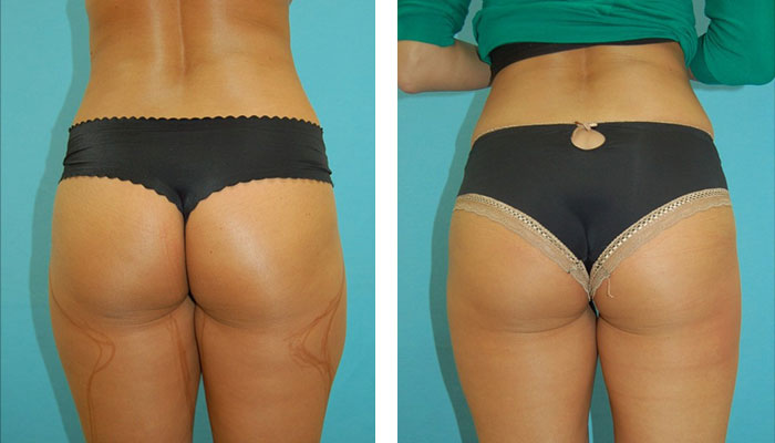 before & after photo of Liposuction