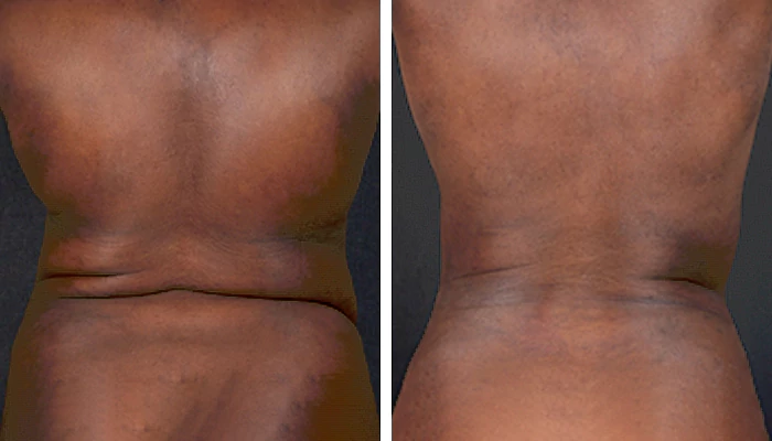 before & after photo of liposuction