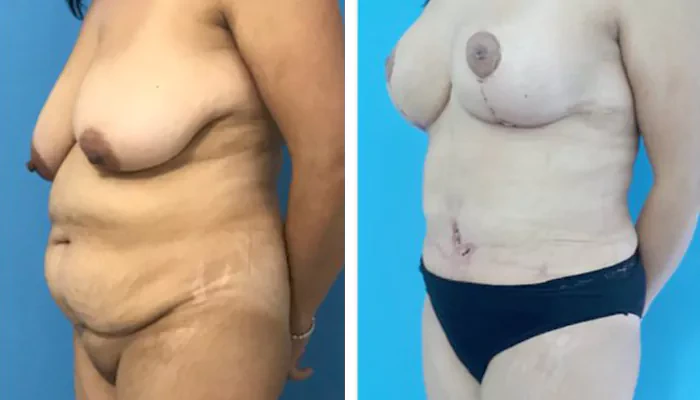 before & after photo of Mommy Makeover