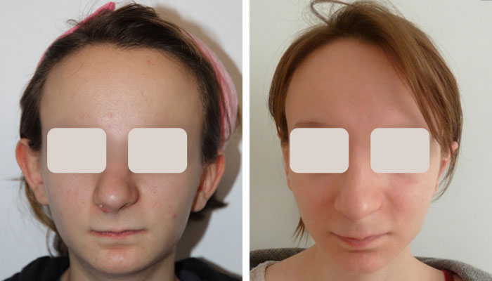 before & after photo of otoplasty