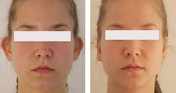 before & after photo of Otoplasty