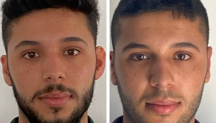 before & after photo of عملية تجميل الأذن