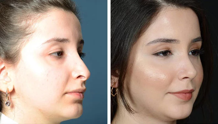 before & after photo of revision-rhinoplasty