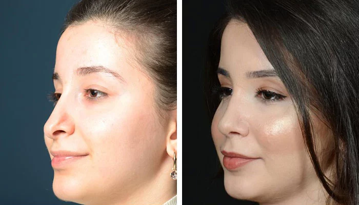 before & after photo of revision-rhinoplasty
