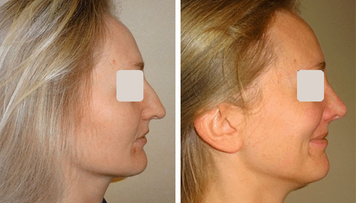 before & after photo of rhinoplasty