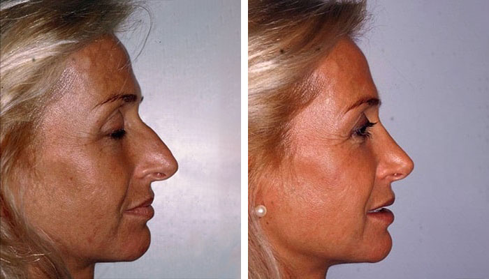 before & after photo of Rhinoplasty